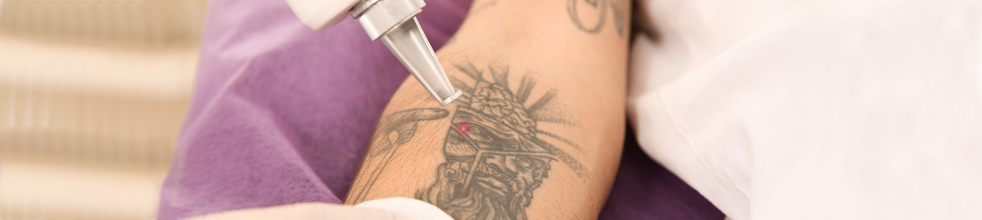 Best Laser Tattoo Removal Treatments Near Me In Richmond VA Area